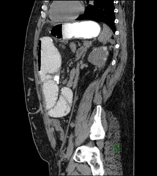 File:Closed-loop small bowel obstruction-internal hernia (Radiopaedia 78439-91096 C 57).jpg