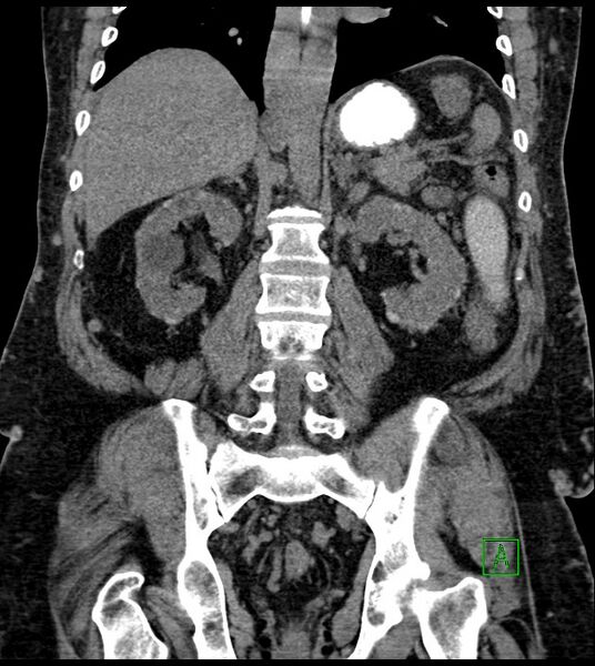 File:Closed-loop small bowel obstruction-internal hernia (Radiopaedia 78439-91096 Coronal non-contrast 68).jpg