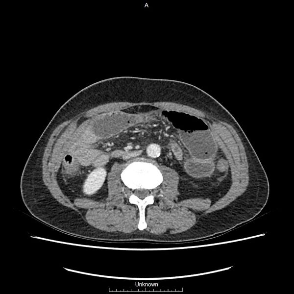 File:Closed loop bowel obstruction and ischemia (Radiopaedia 86959-103180 A 40).jpg