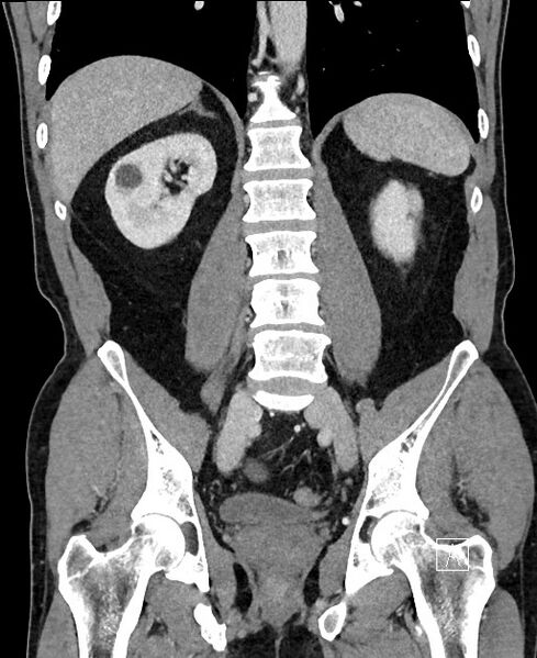 File:Closed loop small bowel obstruction - internal hernia (Radiopaedia 57806-64778 A 77).jpg