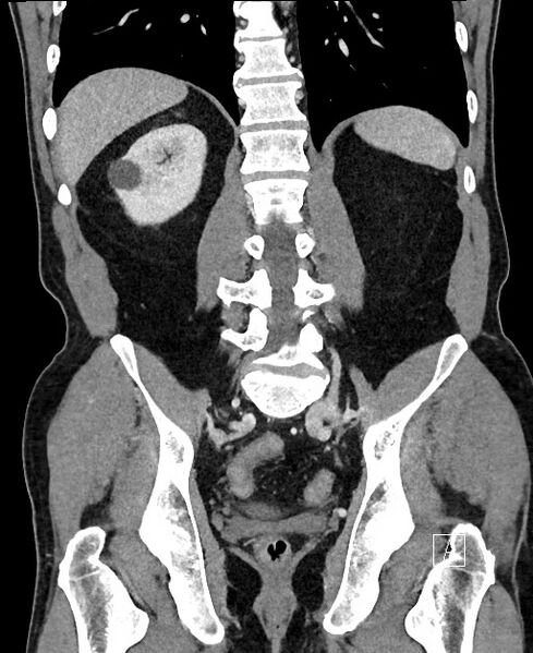 File:Closed loop small bowel obstruction - internal hernia (Radiopaedia 57806-64778 A 83).jpg