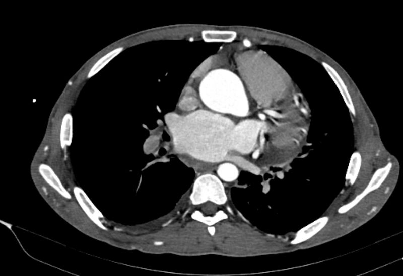 File:Coarctation of aorta with aortic valve stenosis (Radiopaedia 70463-80574 A 105).jpg