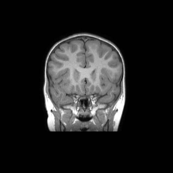File:Cochlear nerve aplasia - unilateral (Radiopaedia 87910-104413 Coronal T1 18).jpg