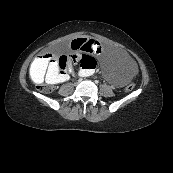 File:Cocoon abdomen with possible tubo-ovarian abscess (Radiopaedia 46235-50636 A 28).png