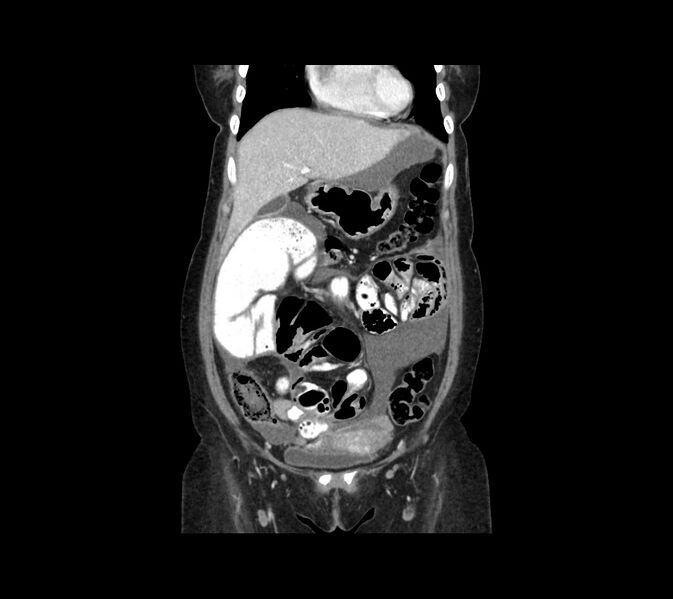 File:Cocoon abdomen with possible tubo-ovarian abscess (Radiopaedia 46235-50636 B 15).jpg
