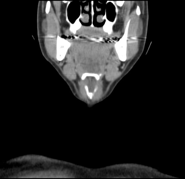 File:Colloid cyst of thyroid (Radiopaedia 22897-22923 Coronal C+ delayed 18).jpg