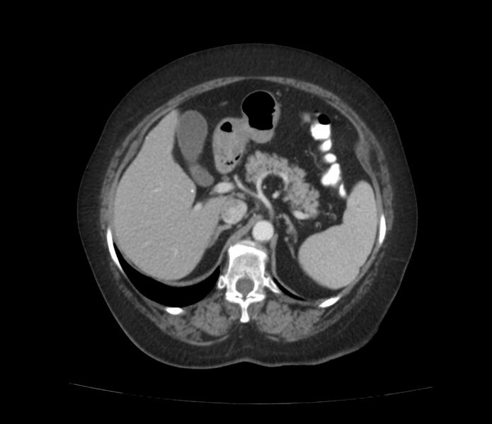 File:Colonic diverticulosis (Radiopaedia 22934-22957 A 20).jpg