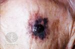 Lentigo maligna (DermNet NZ lesions-lm5).jpg
