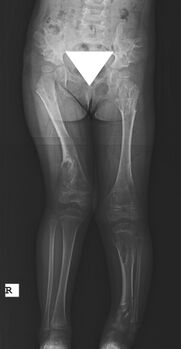 X-ray hips and legs: multiple enchondroma