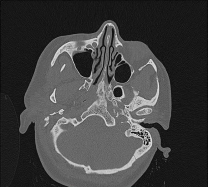 File:Nasolabial cyst (Radiopaedia 25322-25580 Axial bone window 15).jpg