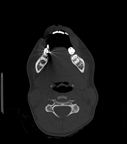 File:Nasoorbitoethmoid fracture (Radiopaedia 90044-107205 Axial bone window 31).jpg