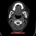 Nasopharyngeal carcinoma recurrence - skull base destruction (Radiopaedia 29107-29491 A 18).jpg