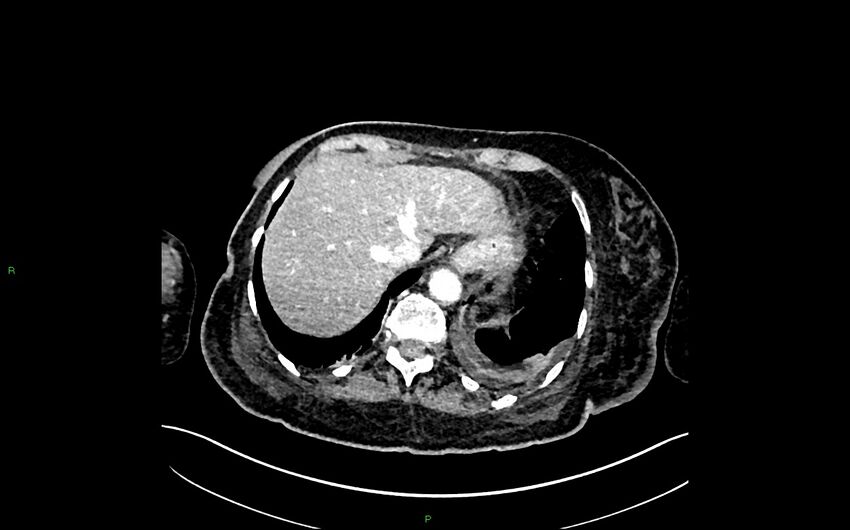 Neo-terminal ileal stricture (Crohn disease) (Radiopaedia 33790-34948 A 56).jpg