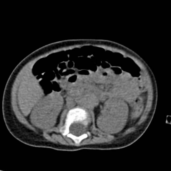 File:Neuroblastoma with skull metastases (Radiopaedia 30326-30960 Axial non-contrast 30).jpg
