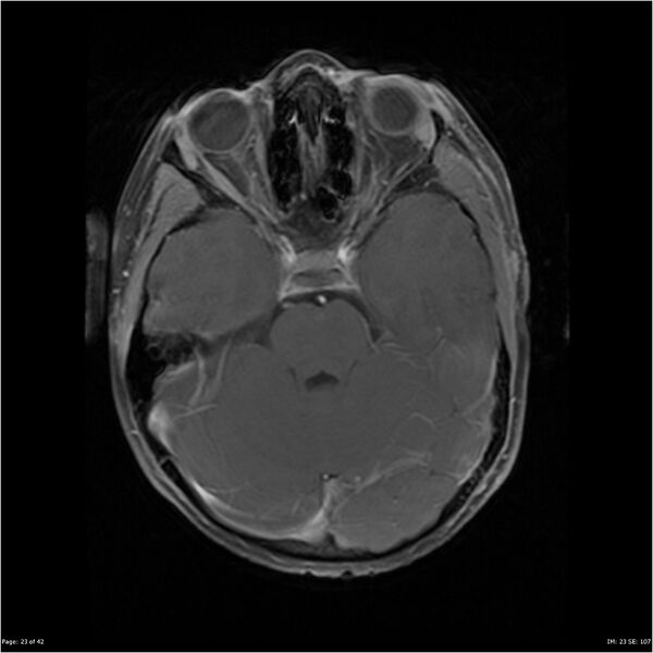 File:Neurofibromatosis type 1 (Radiopaedia 22541-22564 Axial T1 C+ fat sat 23).jpg