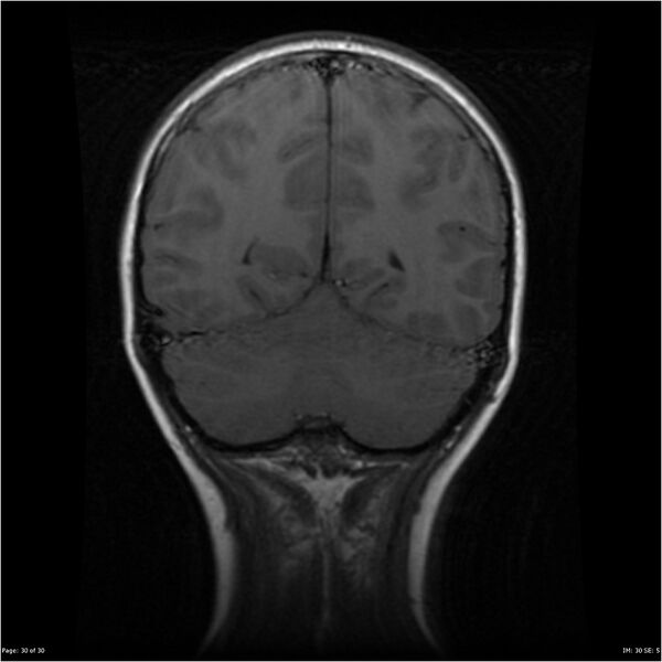 File:Neurofibromatosis type 1 (Radiopaedia 22541-22564 Coronal T1 39).jpg