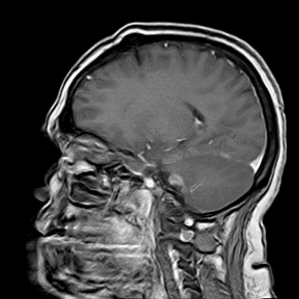 File:Neurofibromatosis type 2 (Radiopaedia 67470-76871 Sagittal T1 C+ 7).jpg
