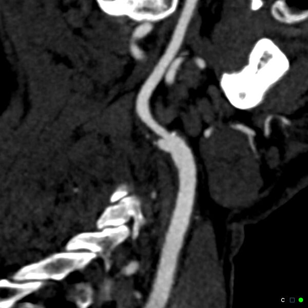 File:Non-occlusive intraluminal internal carotid artery thrombus (Radiopaedia 37751-39658 C 17).jpg