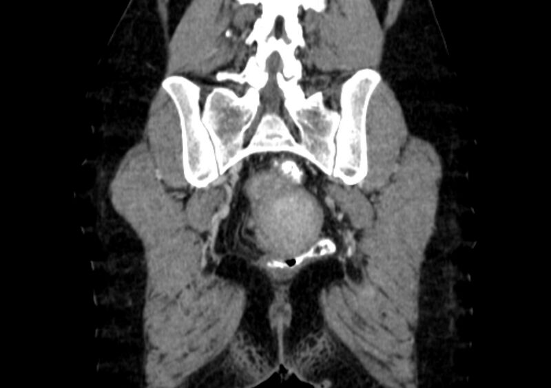 File:Non-puerperal uterine inversion (Radiopaedia 78343-91094 B 53).jpg