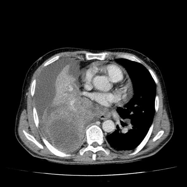 File:Non small-cell lung cancer (Radiopaedia 24467-24769 C+ delayed 34).jpg
