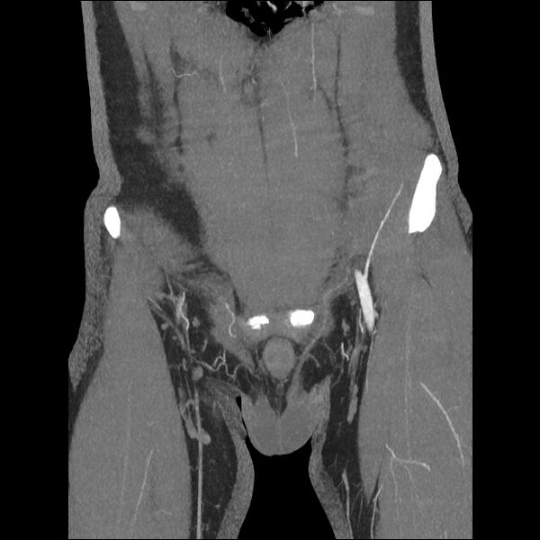 File:Normal CT angiogram of pelvis (Radiopaedia 45390-49430 B 14).jpg