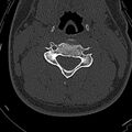 Normal CT of the cervical spine (Radiopaedia 53322-59305 Axial bone window 132).jpg