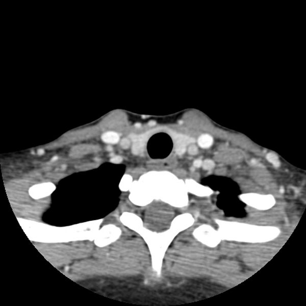 File:Normal CT of the neck (Radiopaedia 14575-14500 Axial C+ 57).jpg