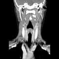 Normal CT of the neck (Radiopaedia 14575-14500 Coronal C+ 28).jpg