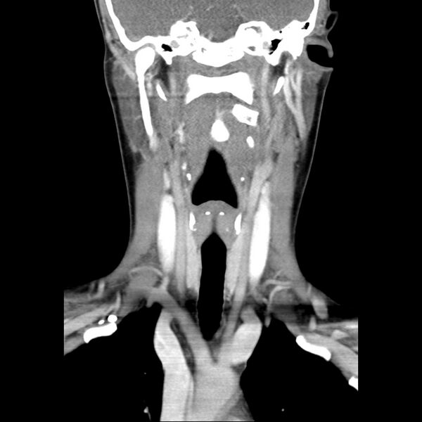 File:Normal CT of the neck (Radiopaedia 14575-14500 Coronal C+ 28).jpg