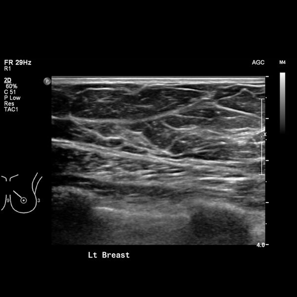File:Normal breast mammography (tomosynthesis) and ultrasound (Radiopaedia 65325-74354 Left breast 12).jpeg