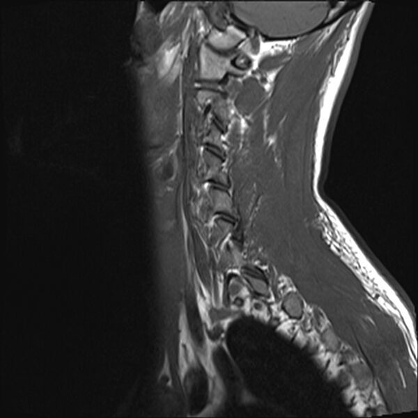 File:Normal cervical spine MRI (Radiopaedia 38418-40496 Sagittal T1 2).jpg