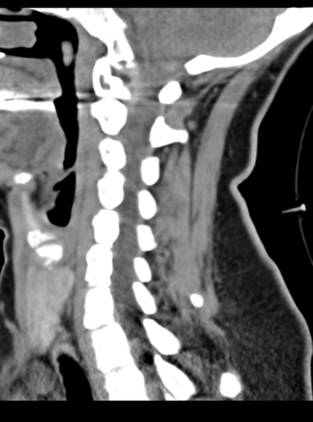 File:Normal cervical spine MRI (including Dixon) (Radiopaedia 42762-45926 C 37).png