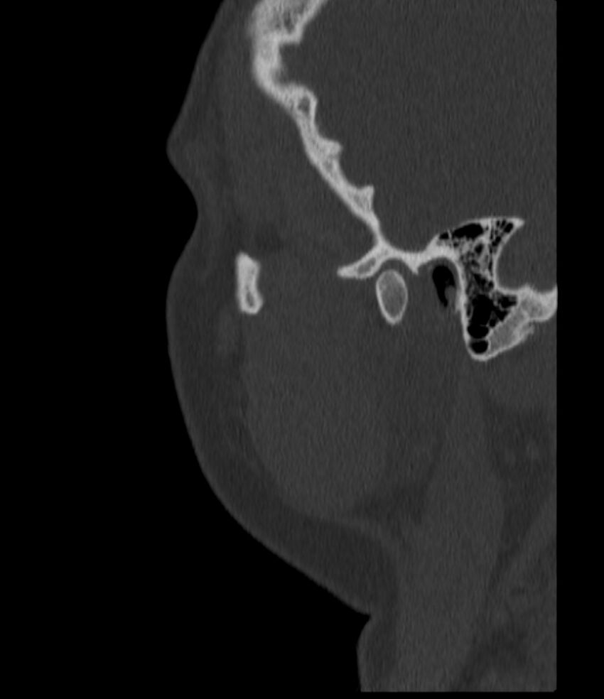 Normal facial bone CT (Radiopaedia 88742-105476 Sagittal bone window 144).jpg
