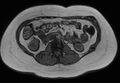 Normal liver MRI with Gadolinium (Radiopaedia 58913-66163 B 8).jpg