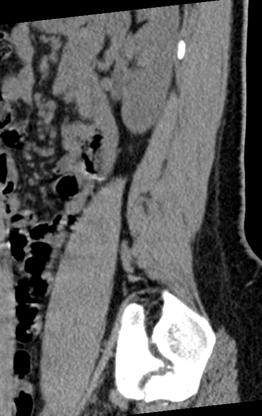 File:Normal lumbar spine CT (Radiopaedia 46533-50986 C 16).png