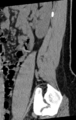 Normal lumbar spine CT (Radiopaedia 46533-50986 C 16).png