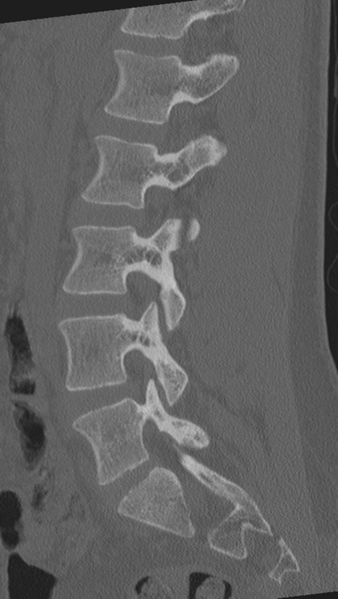 File:Normal lumbar spine CT (Radiopaedia 46533-50986 Sagittal bone window 41).png