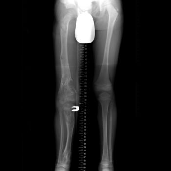 X-ray legs: Ollier disease