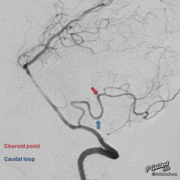 File:PICA - caudal loop and choroid point (annotated image) (Radiopaedia 36151).jpg