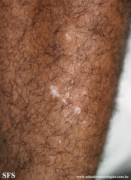 File:Vitiligo (Dermatology Atlas 58).jpg