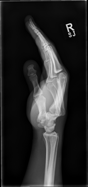 File:4th and 5th carpometacarpal joint dislocations (Radiopaedia 62934-71328 B 1).png