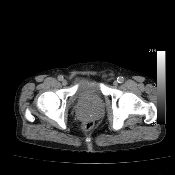 File:Abdominal aortic aneurysm (Radiopaedia 29248-29660 Axial non-contrast 56).jpg