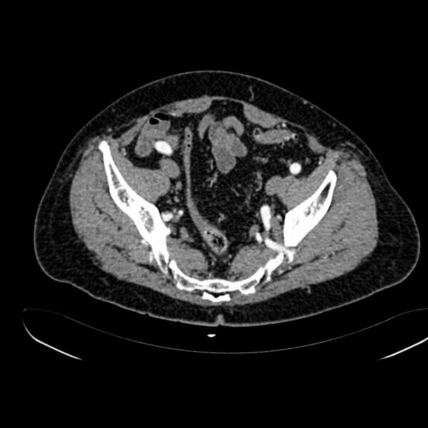 File:Abdominal aortic aneurysm (Radiopaedia 75131-86203 Axial C+ arterial phase 39).jpg