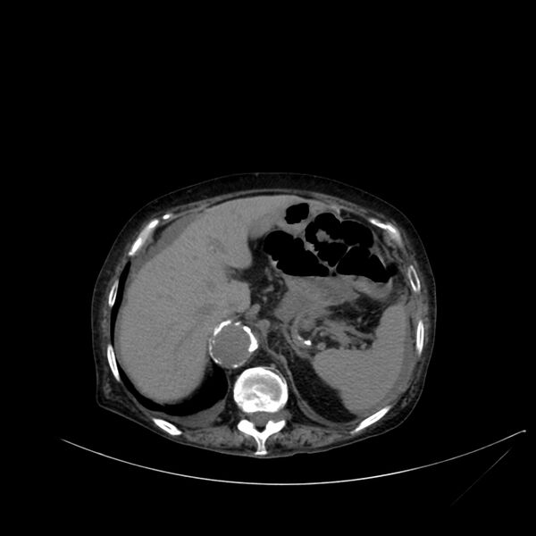 File:Abdominal aortic aneurysm - impending rupture (Radiopaedia 19233-19246 Axial non-contrast 30).jpg