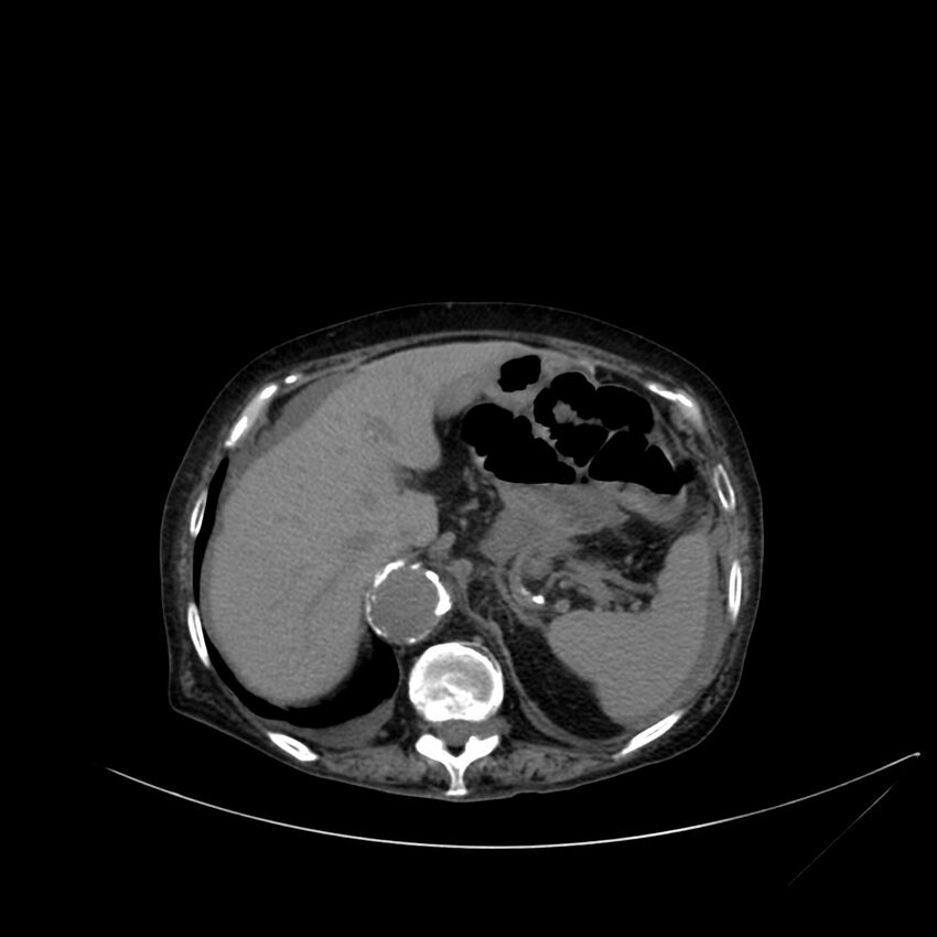 Abdominal aortic aneurysm - impending rupture (Radiopaedia 19233-19246 Axial non-contrast 30).jpg