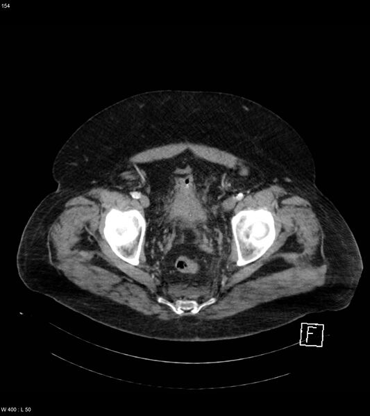 File:Abdominal aortic aneurysm with intramural hematoma then rupture (Radiopaedia 50278-55632 Axial C+ arterial phase 153).jpg