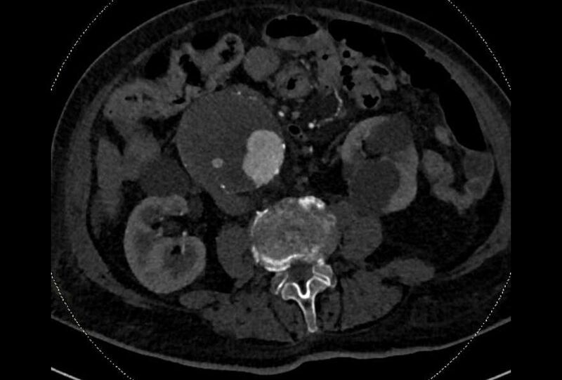 File:Abdominal aortic aneurysm with thrombus fissuration (Radiopaedia 73192-83919 Axial C+ arterial phase 104).jpg