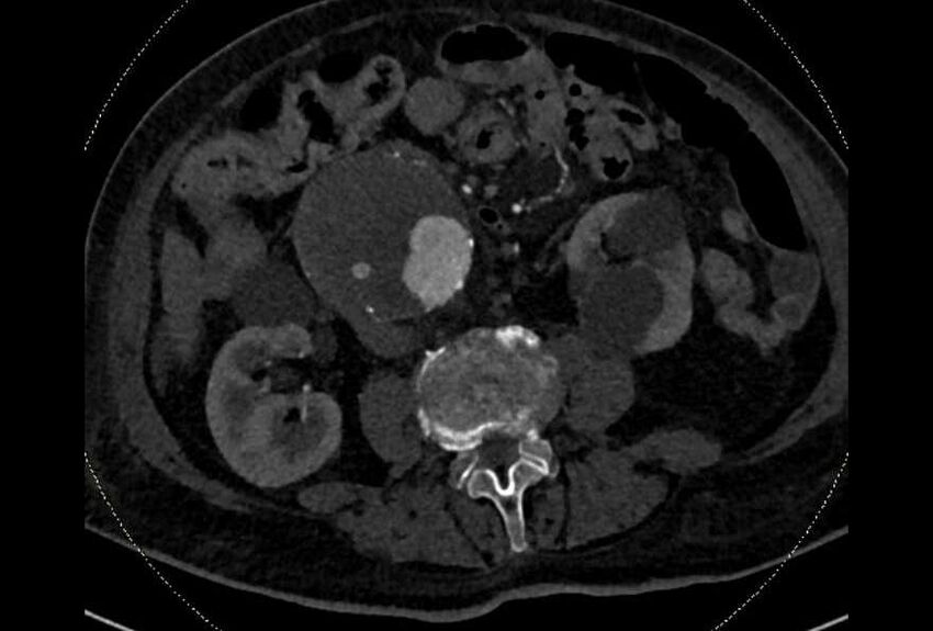 Abdominal aortic aneurysm with thrombus fissuration (Radiopaedia 73192-83919 Axial C+ arterial phase 104).jpg