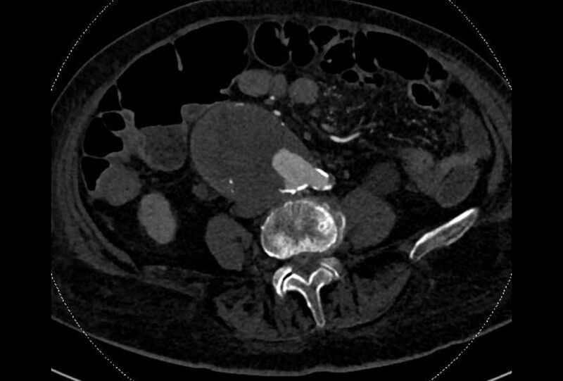 File:Abdominal aortic aneurysm with thrombus fissuration (Radiopaedia 73192-83919 Axial C+ arterial phase 132).jpg