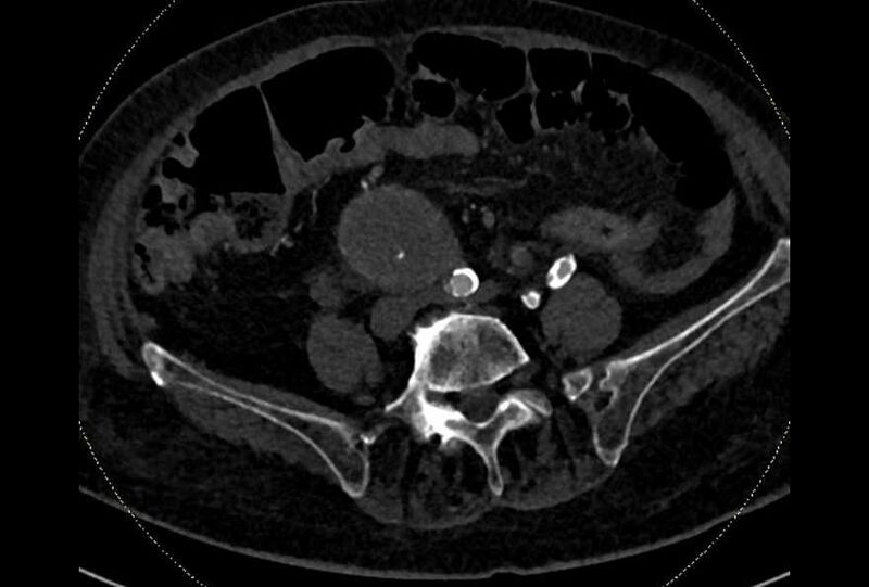 File:Abdominal aortic aneurysm with thrombus fissuration (Radiopaedia 73192-83919 Axial C+ arterial phase 146).jpg